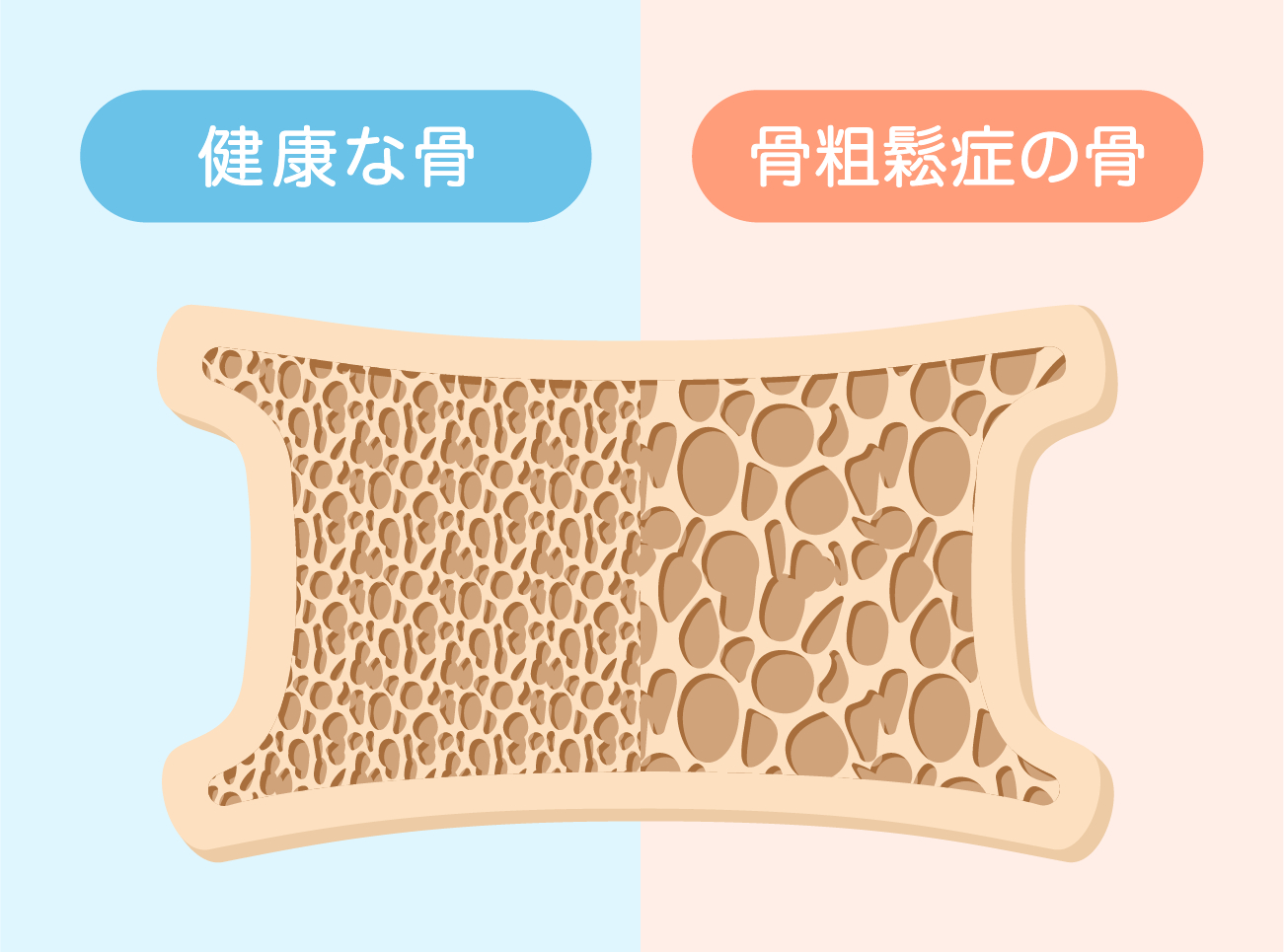 骨粗鬆症 で 正しい の は どれ か